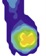 F-Scan HeelWedge Standard Surgical Shoe